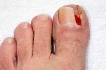 ingrown toenail