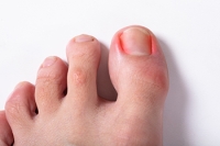 Why Do Ingrown Toenails Occur?