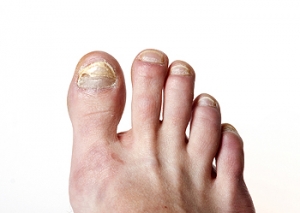 Tackling Toenail Fungus