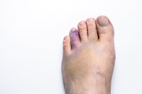 Broken Toes Can Result in Complications