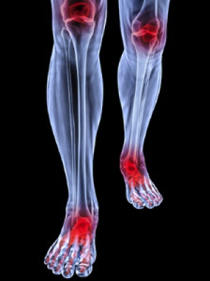 RA Can Affect the Feet