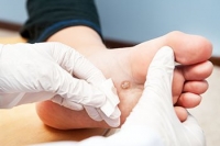 Recognizing and Treating Plantar Warts