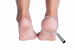 Dry, Cracked Heels in Children