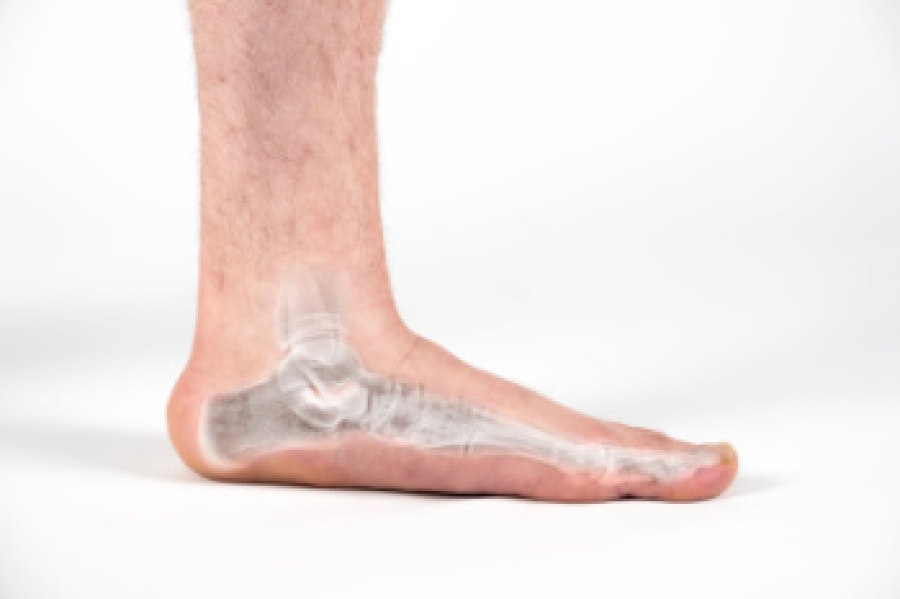 Exploring Surgical Options for Flat Feet
